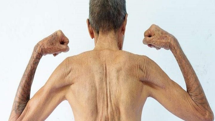 Sarcopenia